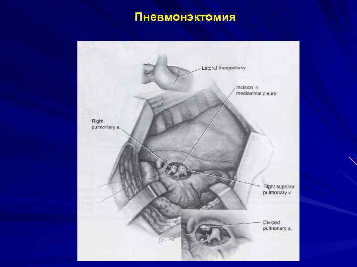 Пневмонэктомия 
