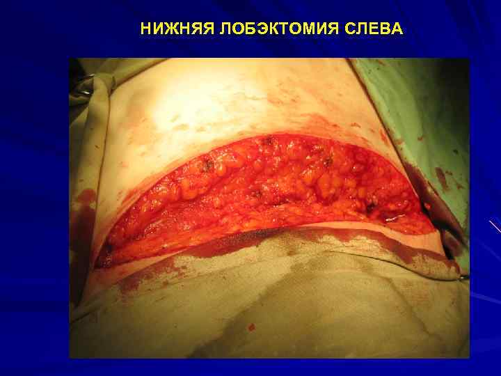 НИЖНЯЯ ЛОБЭКТОМИЯ СЛЕВА 
