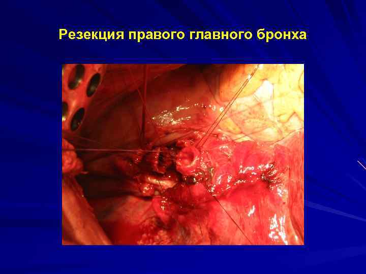 Резекция правого главного бронха 