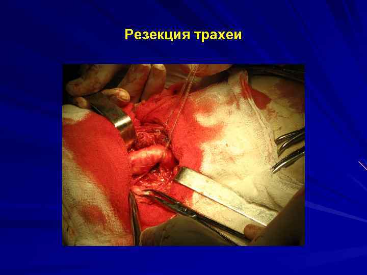 Резекция трахеи 