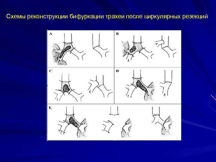 Схемы реконструкции бифуркации трахеи после циркулярных резекций 