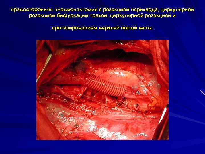 правосторонняя пневмонэктомия с резекцией перикарда, циркулярной резекцией бифуркации трахеи, циркулярной резекцией и протезированием верхней