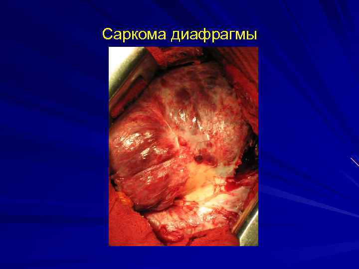 Саркома диафрагмы 