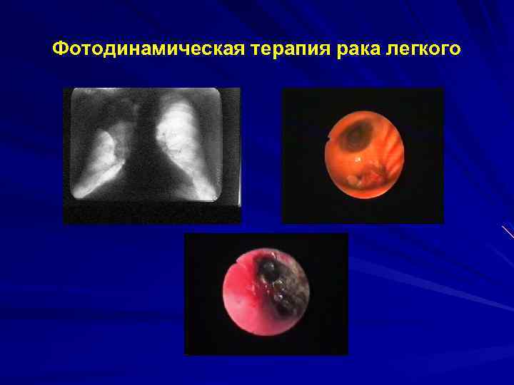 Фотодинамическая терапия рака легкого 