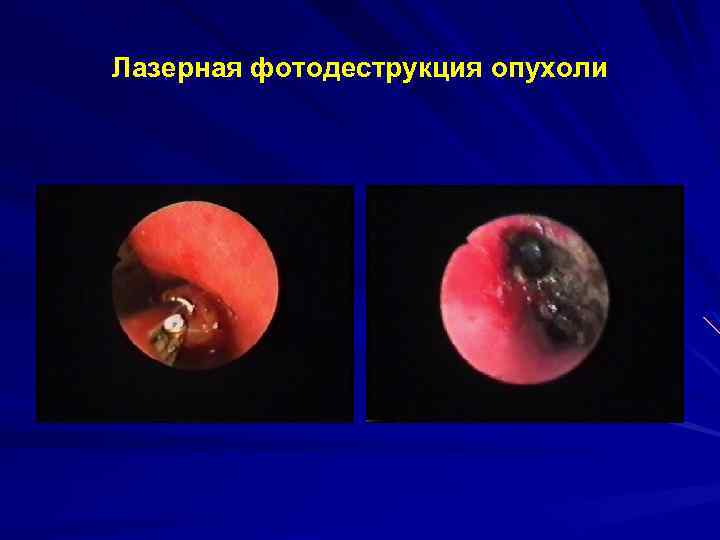 Лазерная фотодеструкция опухоли 