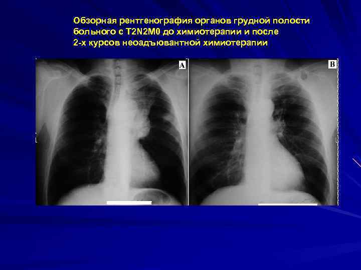 Обзорная рентгенография органов грудной полости больного с Т 2 N 2 М 0 до