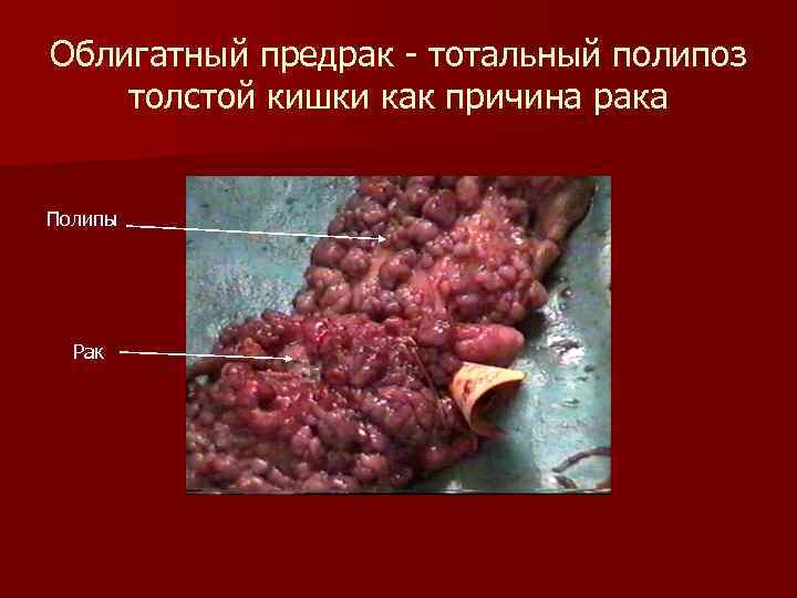 Облигатный предрак тотальный полипоз толстой кишки как причина рака Полипы Рак 