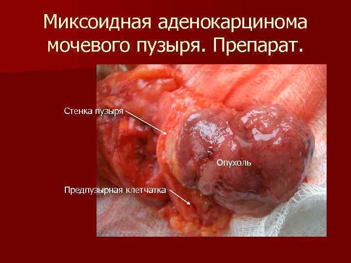 Миксоидная аденокарцинома мочевого пузыря. Препарат. Стенка пузыря Опухоль Предпузырная клетчатка 