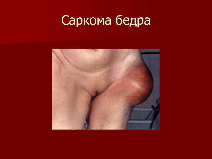 Саркома бедра 