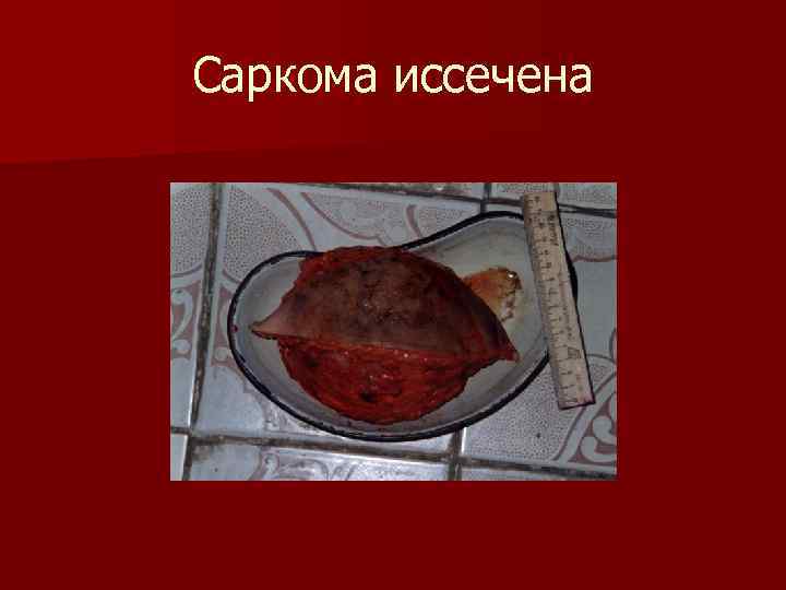 Саркома иссечена 