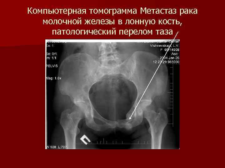 Компьютерная томограмма Метастаз рака молочной железы в лонную кость, патологический перелом таза 