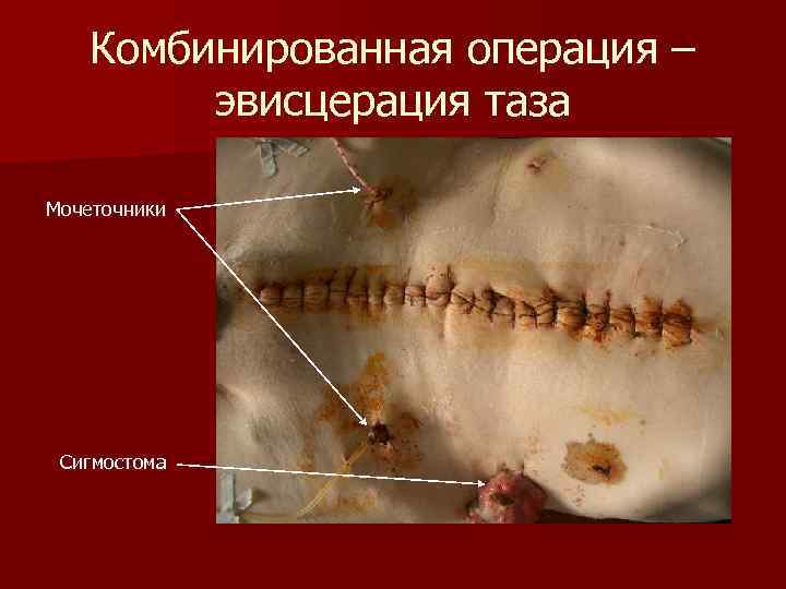  Комбинированная операция – эвисцерация таза Мочеточники Сигмостома 