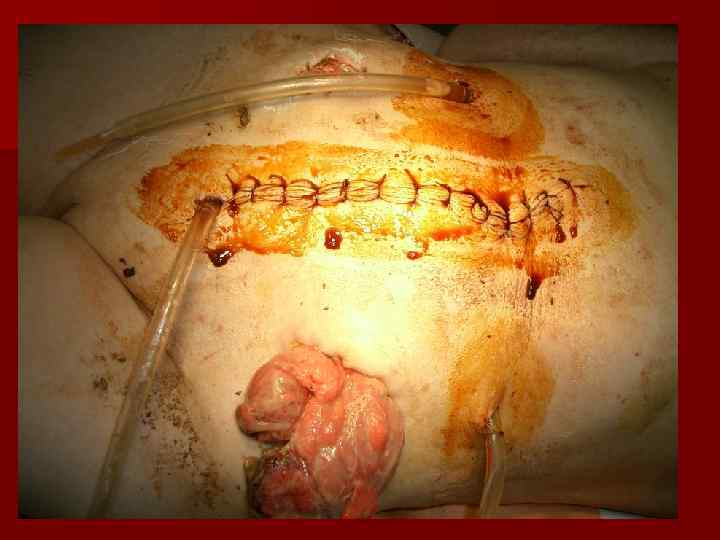   Принципы лечения 1. а/б терапия, пр/грибковая терапия 2. инфузионная терапия- внутриаортально 3.