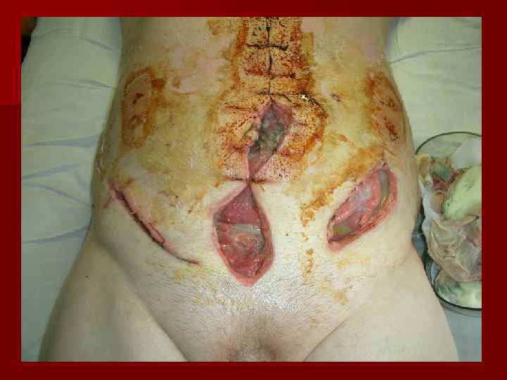   Выбор антибиотиков при перитоните (стартовая    терапия) Внебольничная инфекция: 1.