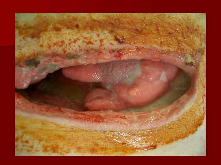  Кандидоз после приема  антибиотиков  Обоснование назначения флуконазола  Фото J S