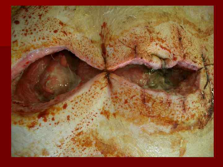   Гнойный плеврит   (эмпиема плевры) n Этовоспаление плевры,  характеризующееся образованием