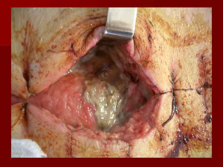   Этиология плеврита n Микроорганизмы (чаще стафилококк),  попавшие в результате заболевания легких