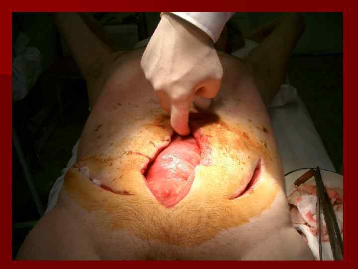   Классификация плеврита n По характеру экссудата или его  отсутствию: серозный, гнойный,