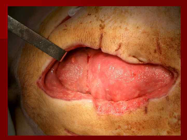    Местные симптомы n Больв грудной клетке, усиливающаяся при вдохе, затрудненное дыхание,