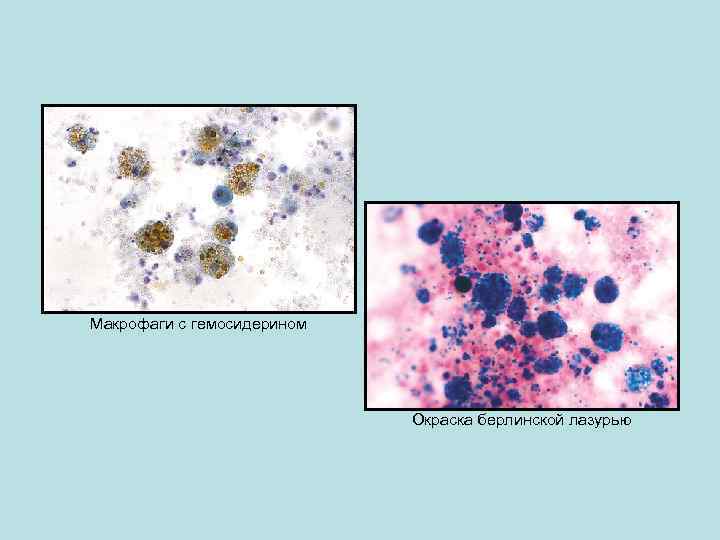 Макрофаги с гемосидерином Окраска берлинской лазурью 