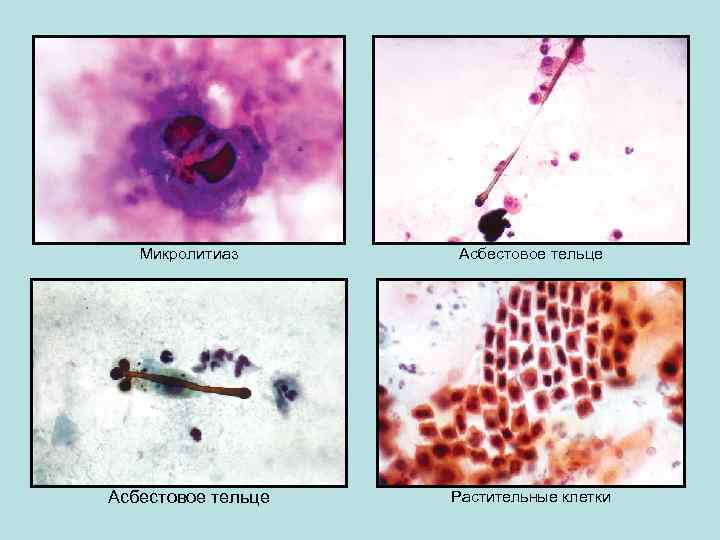 Микролитиаз Асбестовое тельце Растительные клетки 