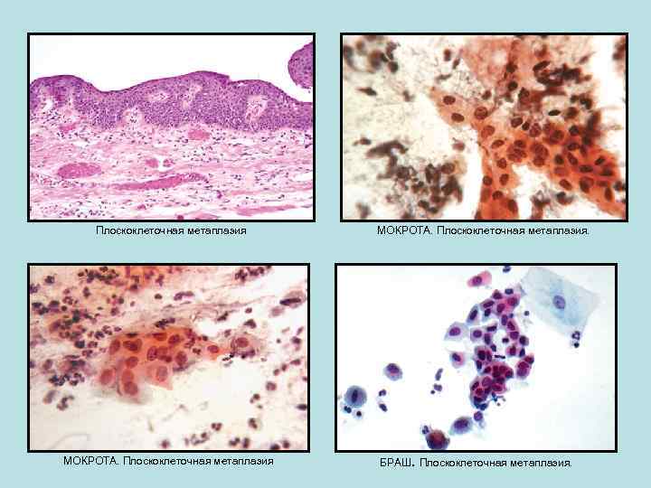 Плоскоклеточная метаплазия МОКРОТА. Плоскоклеточная метаплазия. БРАШ. Плоскоклеточная метаплазия. 