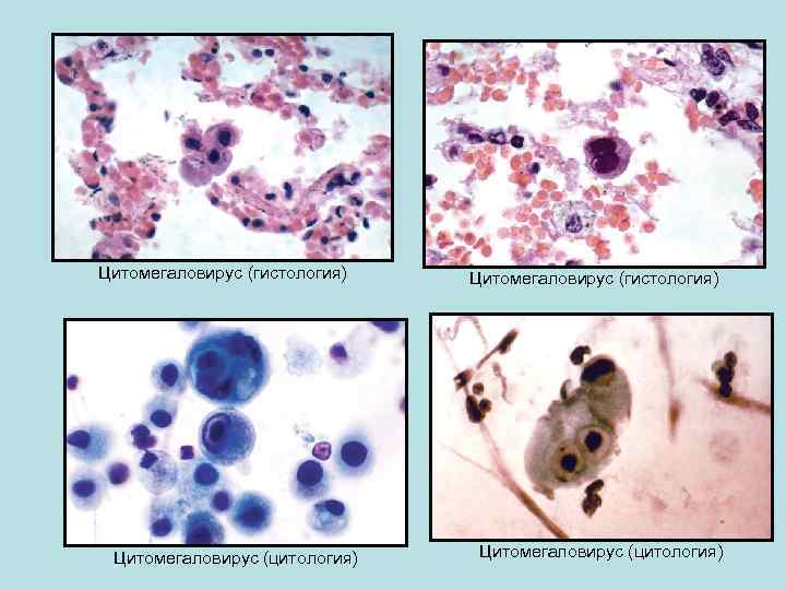 Цитомегаловирус (гистология) Цитомегаловирус (цитология) 