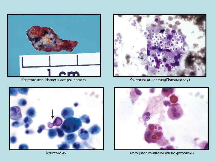 Криптококкоз. Напоминает рак легкого. Криптококки, капсула(Папаниколау) Фагоцитоз криптококков макрофагами 