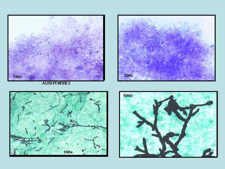 АСПЕРГИЛЛЕЗ 