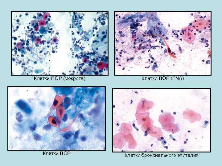 Клетки ПОР (мокрота) Клетки ПОР (FNA) Клетки бронхиального эпителия 