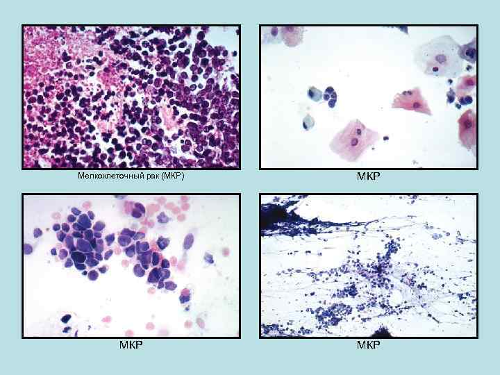 Мелкоклеточный рак (МКР) МКР МКР 