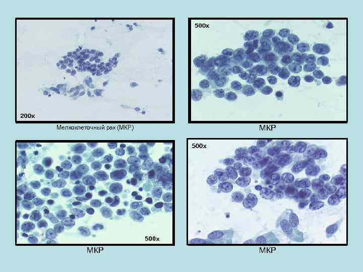 Мелкоклеточный рак (МКР) МКР МКР 