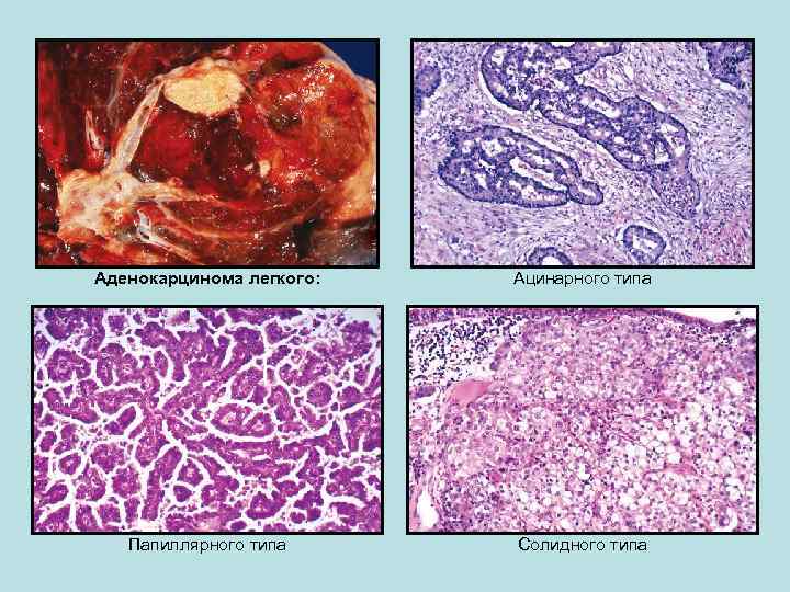 Аденокарцинома легкого: Ацинарного типа Папиллярного типа Солидного типа 