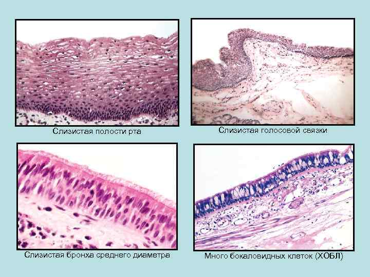 Слизистая полости рта Слизистая голосовой связки Слизистая бронха среднего диаметра Много бокаловидных клеток (ХОБЛ)