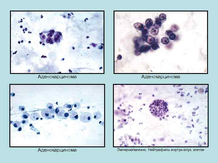 Аденокарцинома Эмпериополезис. Нейтрофилы внутри опух. клеток 