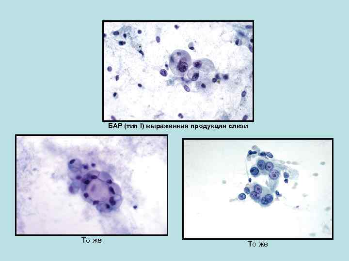 БАР (тип I) выраженная продукция слизи То же 