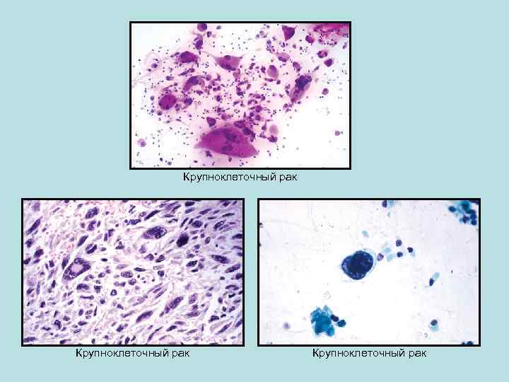 Крупноклеточный рак 