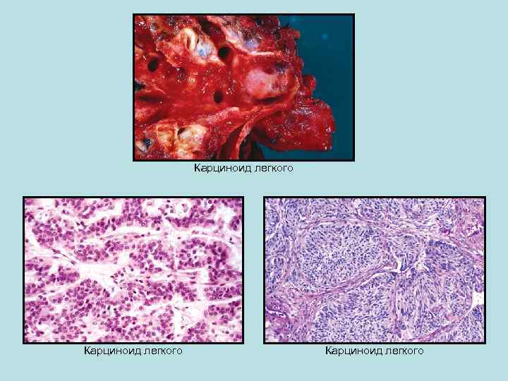 Карциноид легкого 