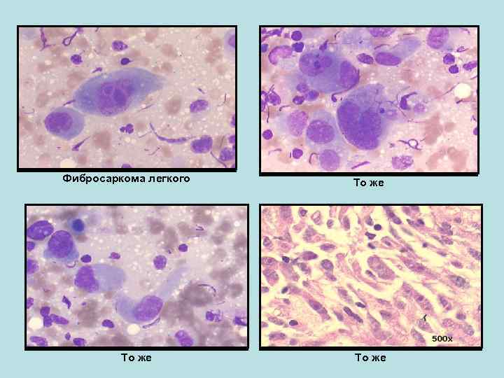 Фибросаркома микропрепарат рисунок