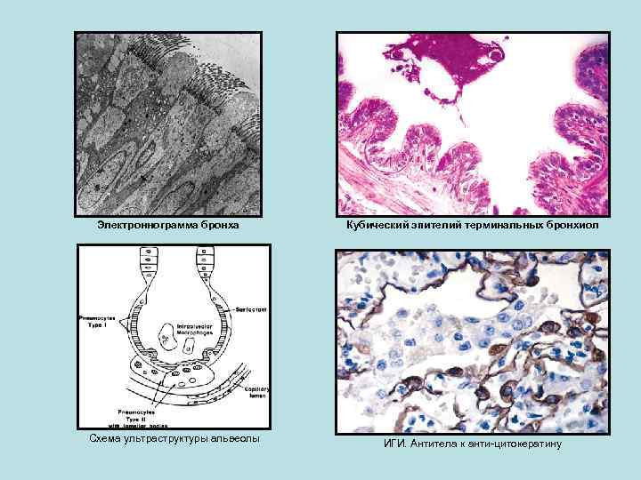 Электроннограмма бронха Схема ультраструктуры альвеолы Кубический эпителий терминальных бронхиол ИГИ. Антитела к анти-цитокератину 