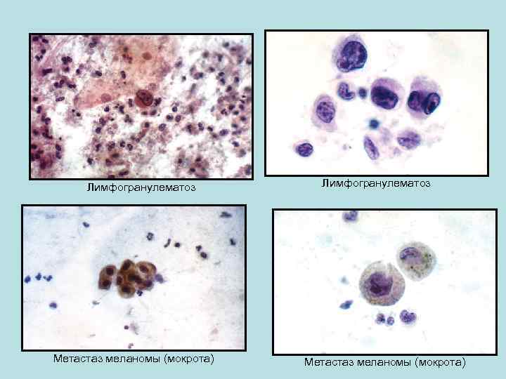 Лимфогранулематоз Метастаз меланомы (мокрота) 