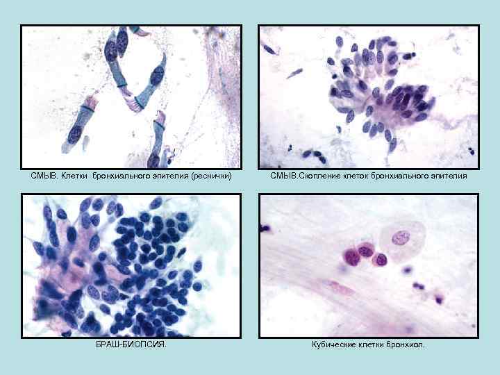 СМЫВ. Клетки бронхиального эпителия (реснички) СМЫВ. Скопление клеток бронхиального эпителия БРАШ-БИОПСИЯ. Кубические клетки бронхиол.