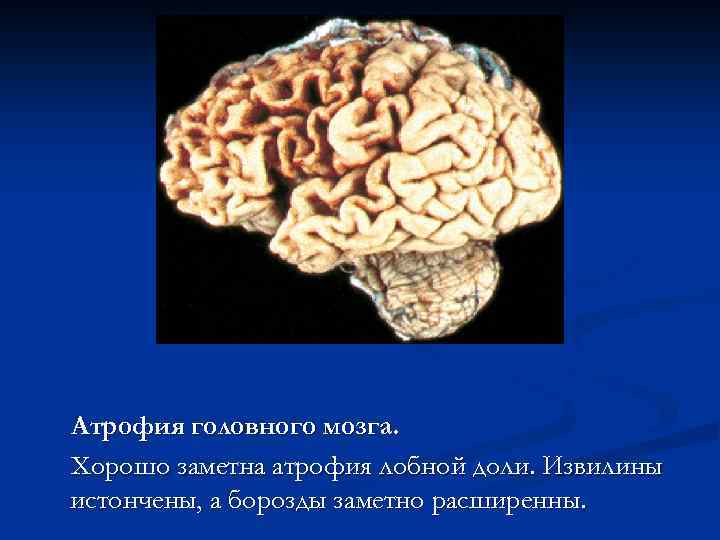 Атрофия головного мозга. Хорошо заметна атрофия лобной доли. Извилины истончены, а борозды заметно расширенны.
