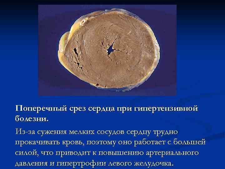 Поперечный срез сердца при гипертензивной болезни. Из-за сужения мелких сосудов сердцу трудно прокачивать кровь,