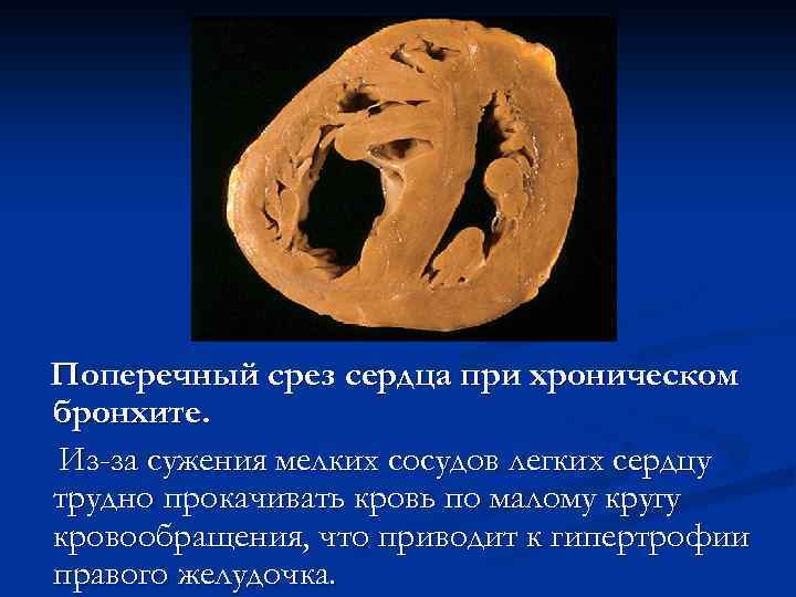 Поперечный срез сердца при хроническом бронхите. Из-за сужения мелких сосудов легких сердцу трудно прокачивать