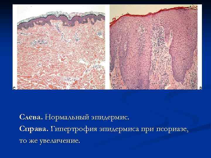 Cлева. Нормальный эпидермис. Справа. Гипертрофия эпидермиса при псориазе, то же увеличение. 