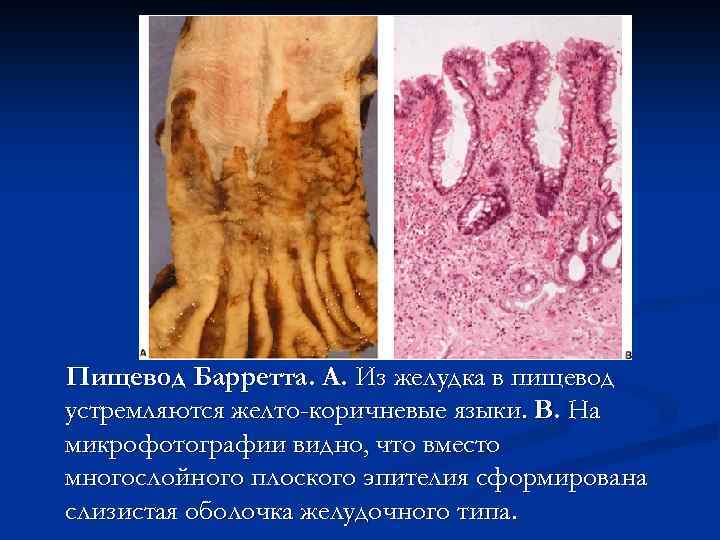 Пищевод Барретта. A. Из желудка в пищевод устремляются желто-коричневые языки. B. На микрофотографии видно,