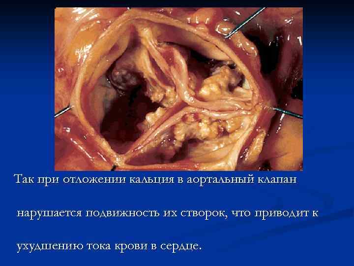 Так при отложении кальция в аортальный клапан нарушается подвижность их створок, что приводит к