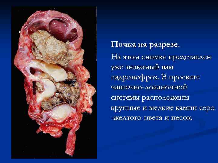 Почка на разрезе. На этом снимке представлен уже знакомый вам гидронефроз. В просвете чашечно-лоханочной