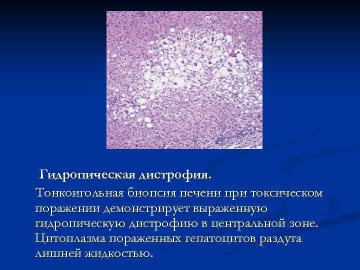 Гидропическая дистрофия. Тонкоигольная биопсия печени при токсическом поражении демонстрирует выраженную гидропическую дистрофию в центральной